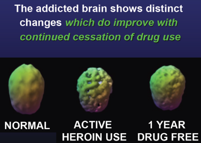 addicted-brain
